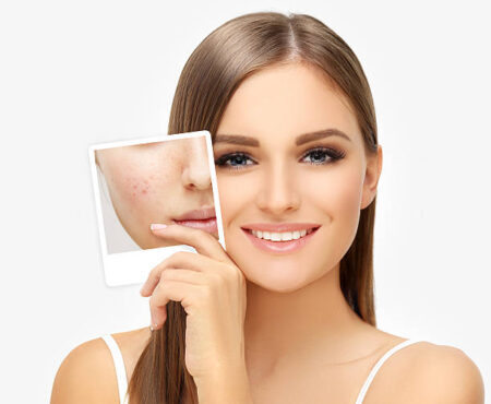 Acne Naturally